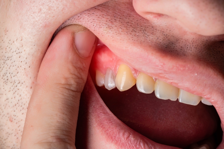 Can Gums Recover from Gum Disease?