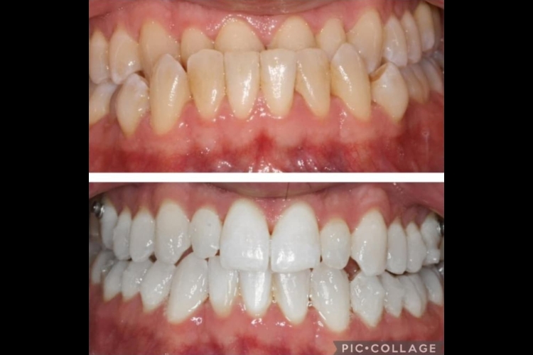 Teeth straightening at Church Lane Dental