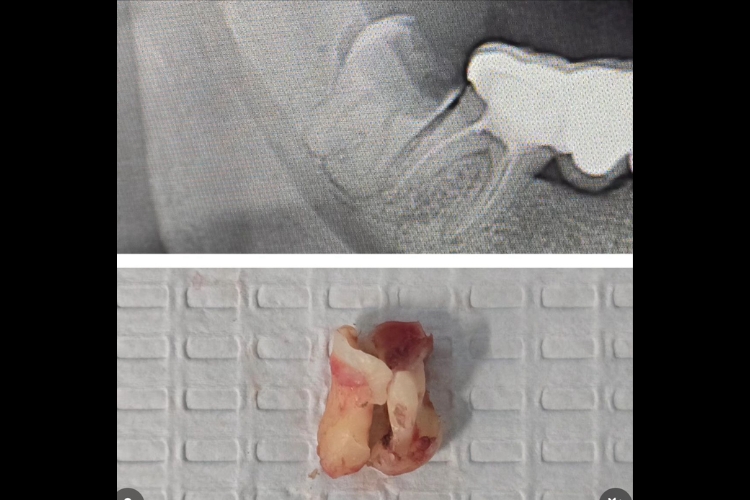 Impacted Carious Bulbous Wisdom Tooth Removal