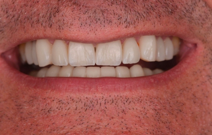 Porcelain Veneers and Clear Braces - Case 1 - after