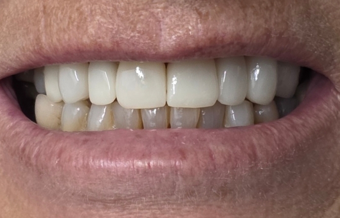 Smile Makeover - Case 1 - after