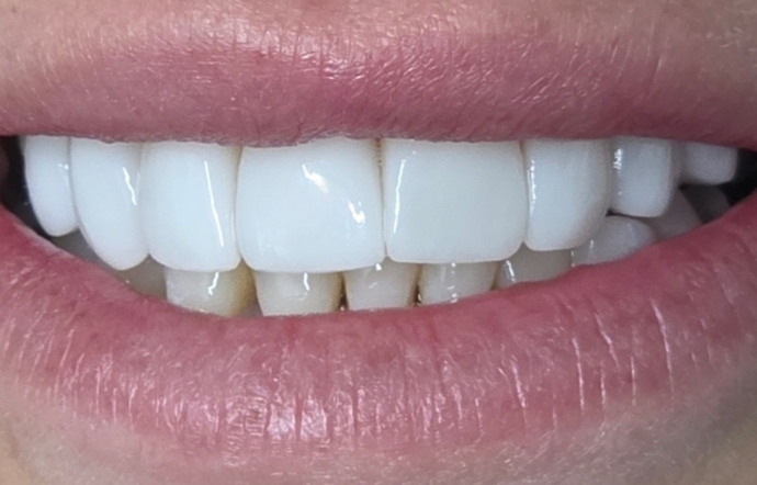 Porcelain Veneers and Clear Braces - Case 4 - after