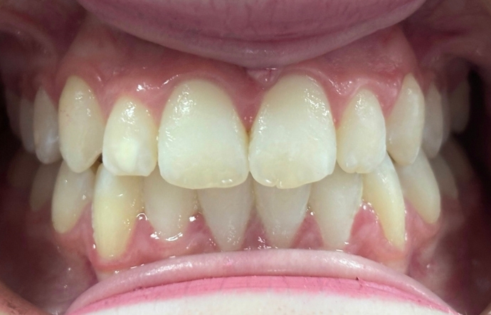 Braces - Case 1 - after