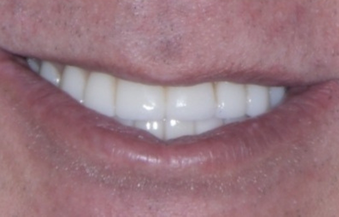 Dental implants - Case 2 - after