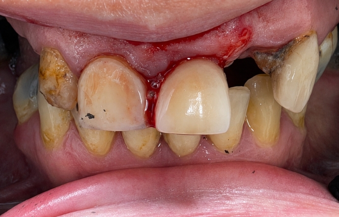 Dental Crowns - Case 1 before
