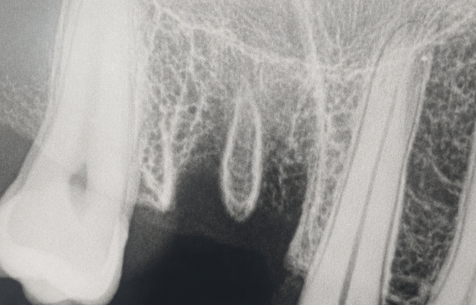 Dental Implants - Case 3 before