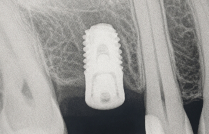 Dental Implants - Case 3 after