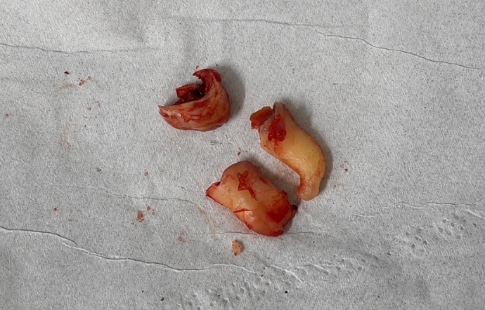 Wisdom Tooth Extraction - Case 1 after