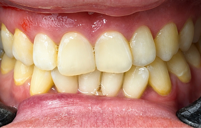 Cosmetic Bonding - Case 6 before