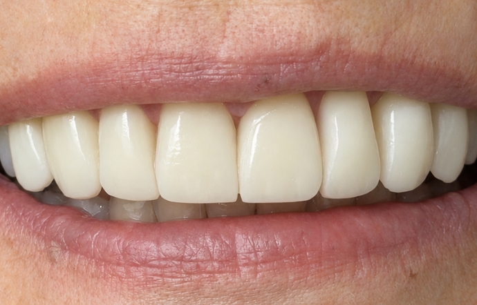 Porcelain Veneers - Case 3 after